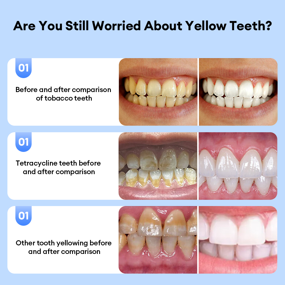 Airuidu TW11 Teeth Whitening Device Set